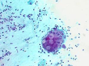 Do I have CHLAMYDIA?