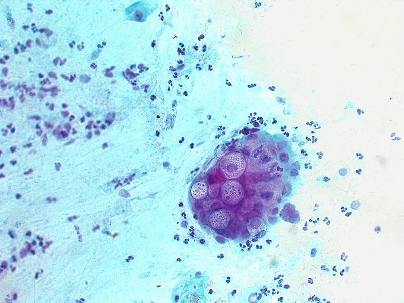 Do I have CHLAMYDIA?